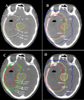 Comparative dosimetric study of radiotherapy in high-grade gliomas based on the guidelines of EORTC and NRG-2019 target delineation